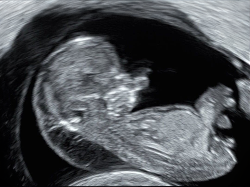 Ecografía original - ejemplo 2